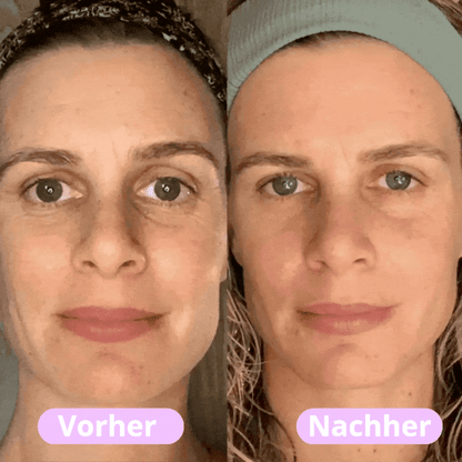 Norlvi - Straffendes LED-Gesichtsmassagegerät